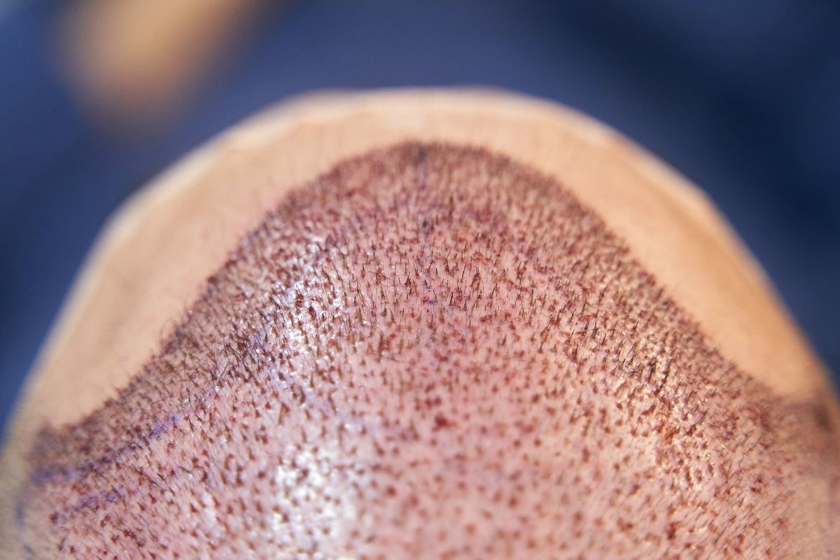 In recent years, DHI Hair Transplant has become one of the most sought-after procedures for individuals struggling with hair loss. Among the renowned locations for this cutting-edge treatment, Antalya, Turkey stands out. This article provides an in-depth look into the Dhı Hair Transplant procedures available in Antalya, from its advantages to finding the right clinic.