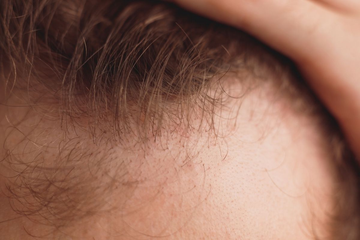 Hair transplant procedures have come a long way, offering solutions to individuals dealing with hair loss and balding. One of the questions that arise is whether people with HIV can undergo hair transplant procedures in Turkey. The good news is that individuals living with HIV can indeed get a hair transplant in Turkey.