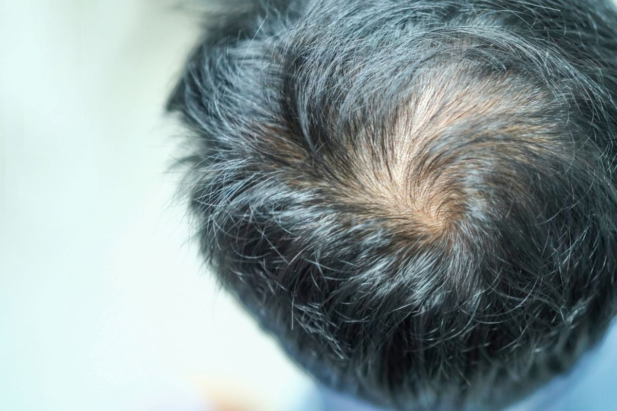 Second Hair Transplant in Turkey Antalya