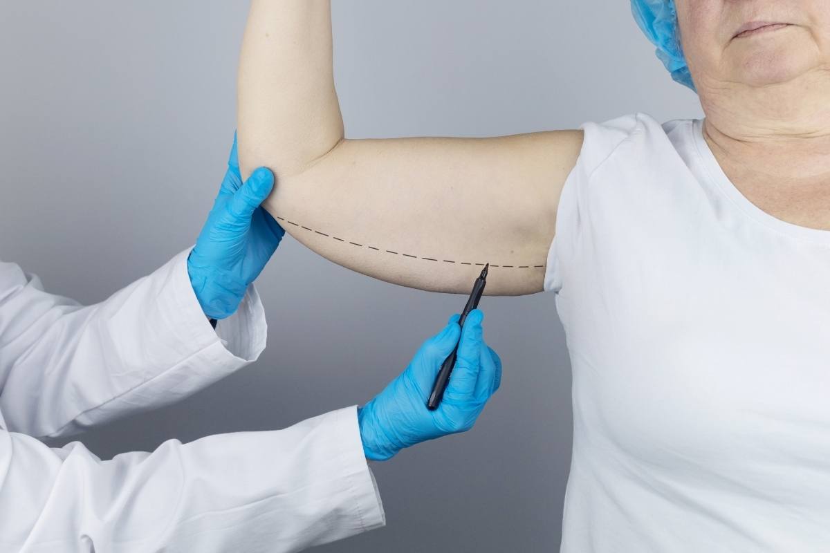 Discover the journey of arm lift surgery recovery, from immediate post-op care to long-term rehabilitation. Learn tips for a smooth healing process.