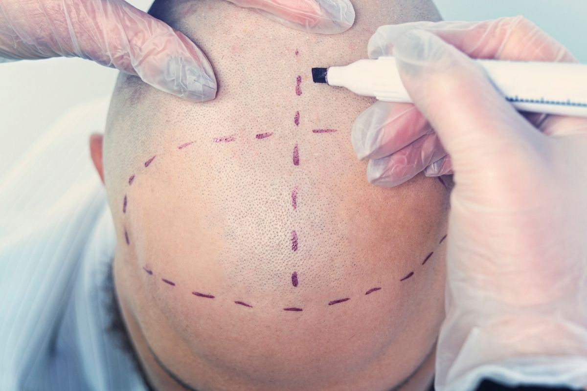 Hair Transplant in Qatar