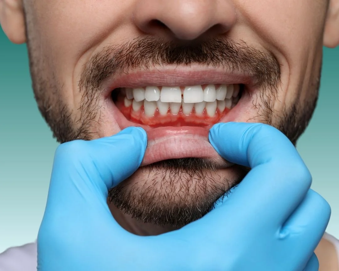 Gum Disase Treatment in Turkey Antalya 2025