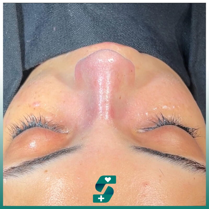 Rhinoplasty in Antalya - Reviews, Cost, Pros & Cons 2025 6 Rhinoplasty Surgery Antalya Patient Photo