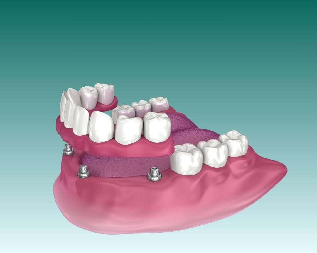 Implanty dentystyczne All On 4 Turcja Antalya Grafika