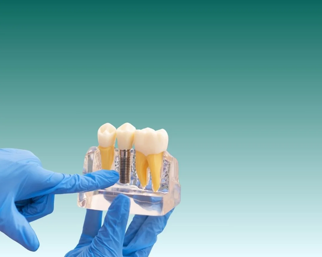 Implantes dentales en Turquía 2025