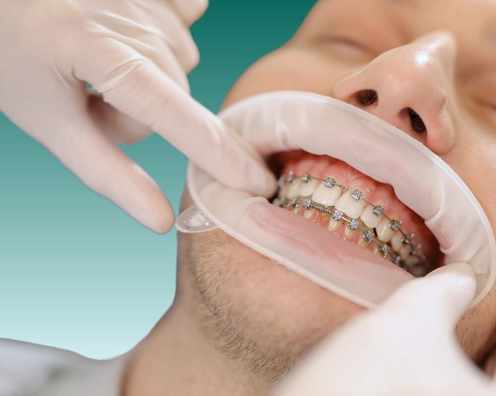 Orthodontic Treatment in Turkey Advantages of Soraca Med
