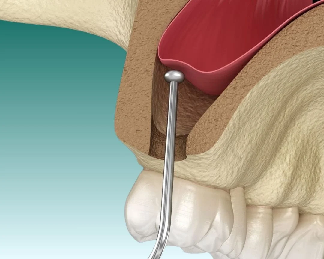 Sinus Lift in Turkey 2025 Soraca Med Price