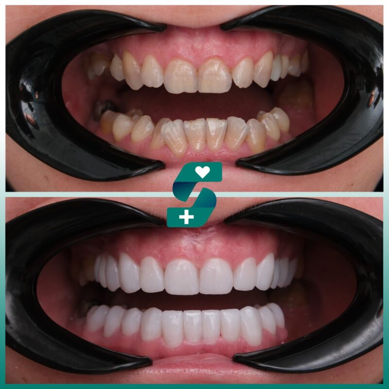 Dental Implants in Alanya - Cost, Procedure, Reviews 2025 3 Dental Treatment 2025