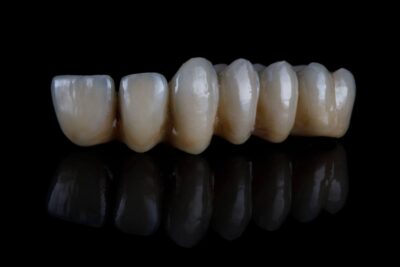 Overdenture prosthesis 4 Overdenture Prosthesis