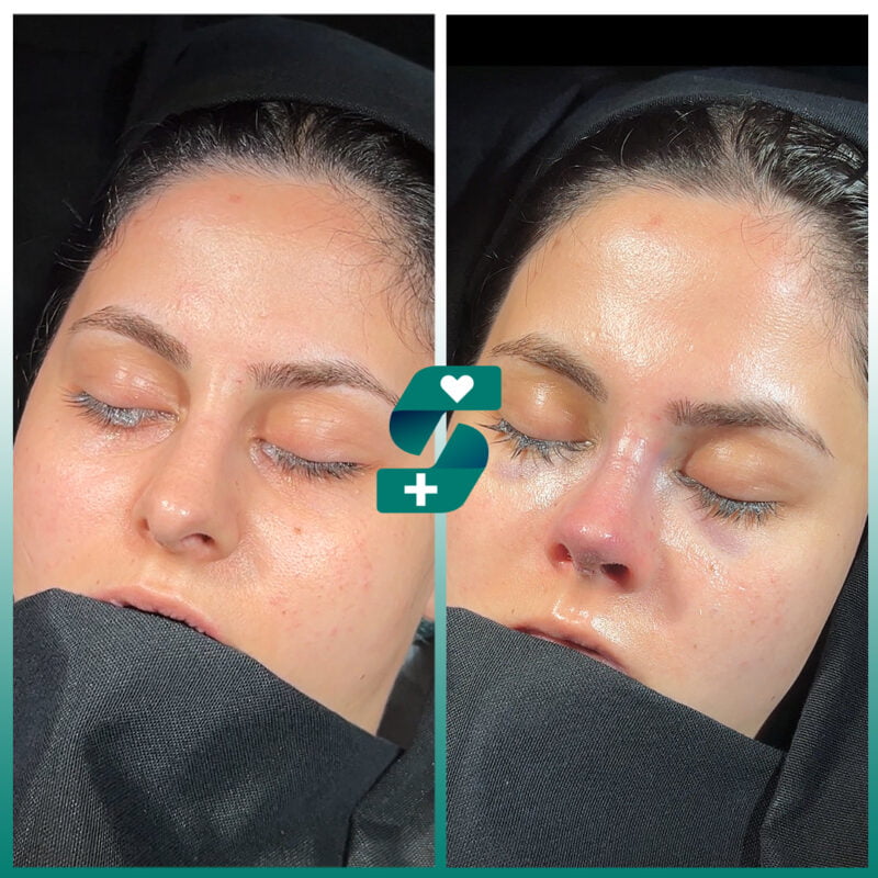 Rhinoplasty in Antalya - Reviews, Cost, Pros & Cons 2025 4 Rhinoplasty Surgery Antalya Turkey