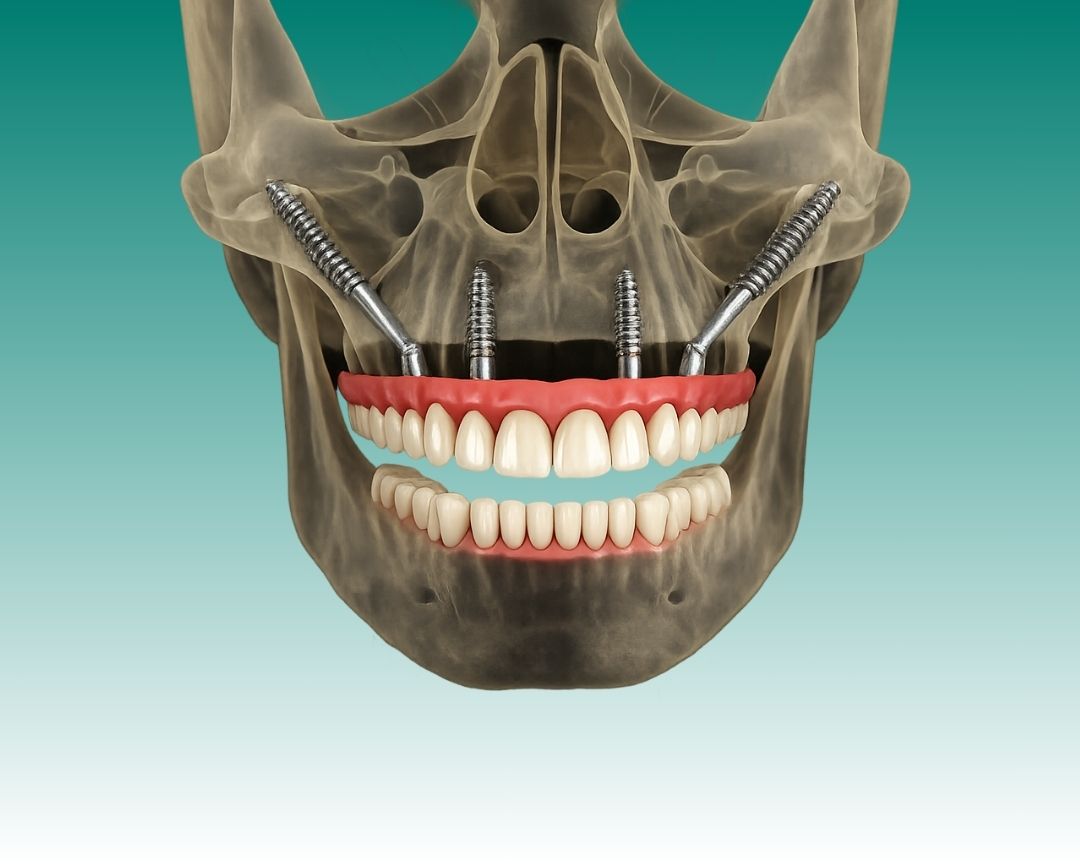 зубные имплантаты в области скуловой кости