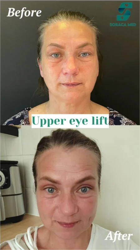 Blefaroplastika v Antalya - Náklady & Ceny, Recenze, Časté dotazy 3 Blefaroplastika V Turecku