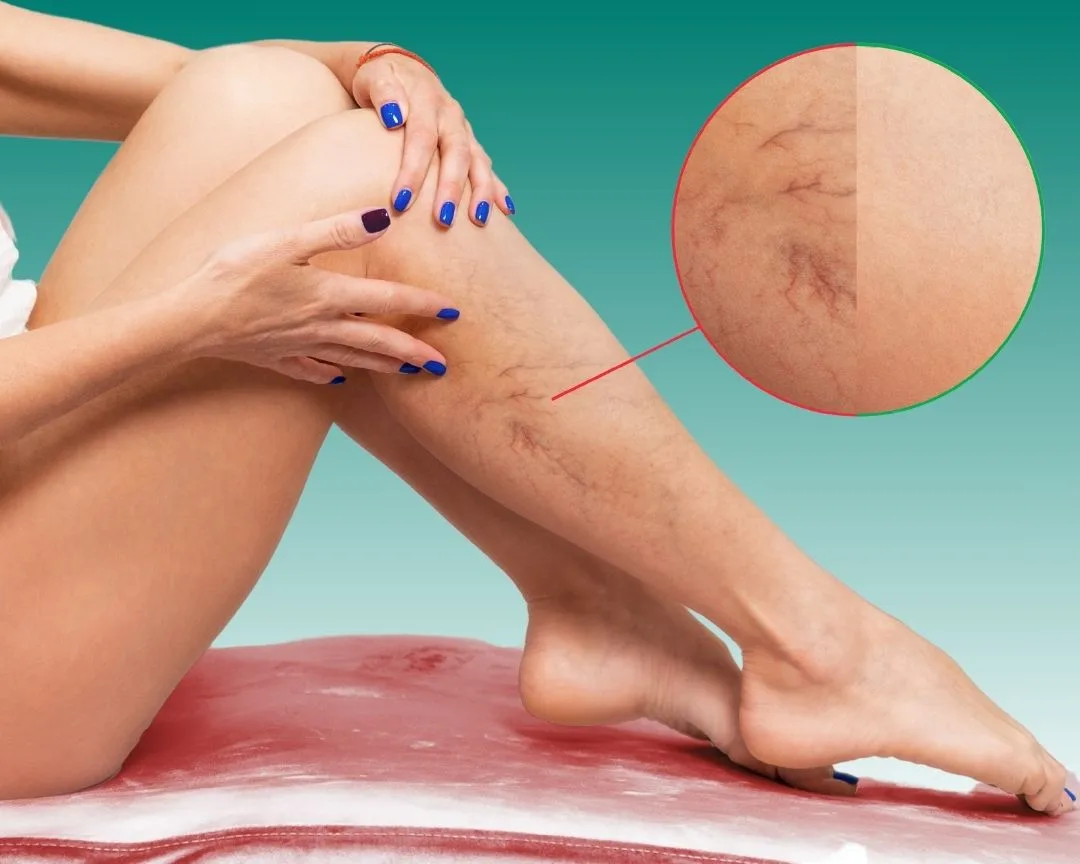 Deep Vein Thrombosis Treatments 2025