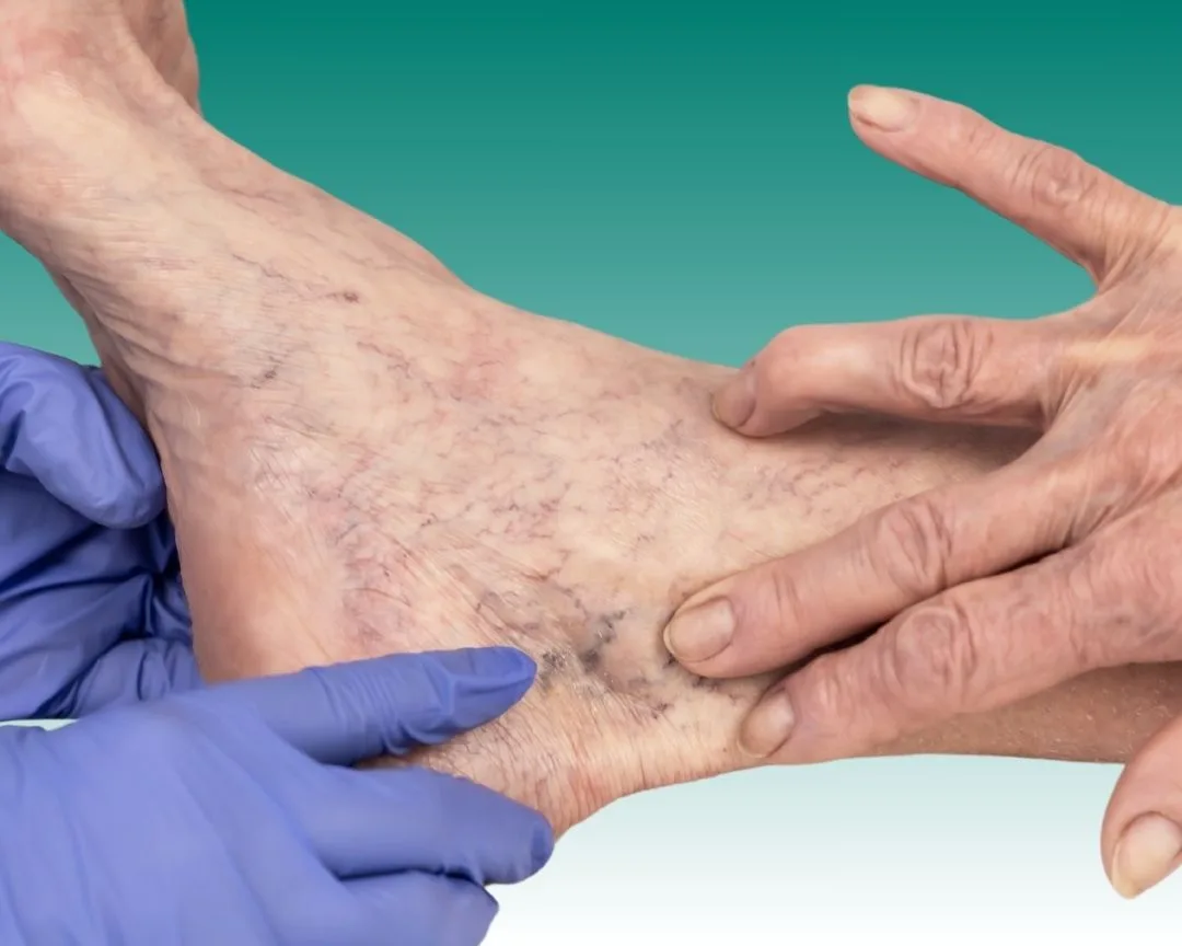 Sclerotherapy Near Me in UK