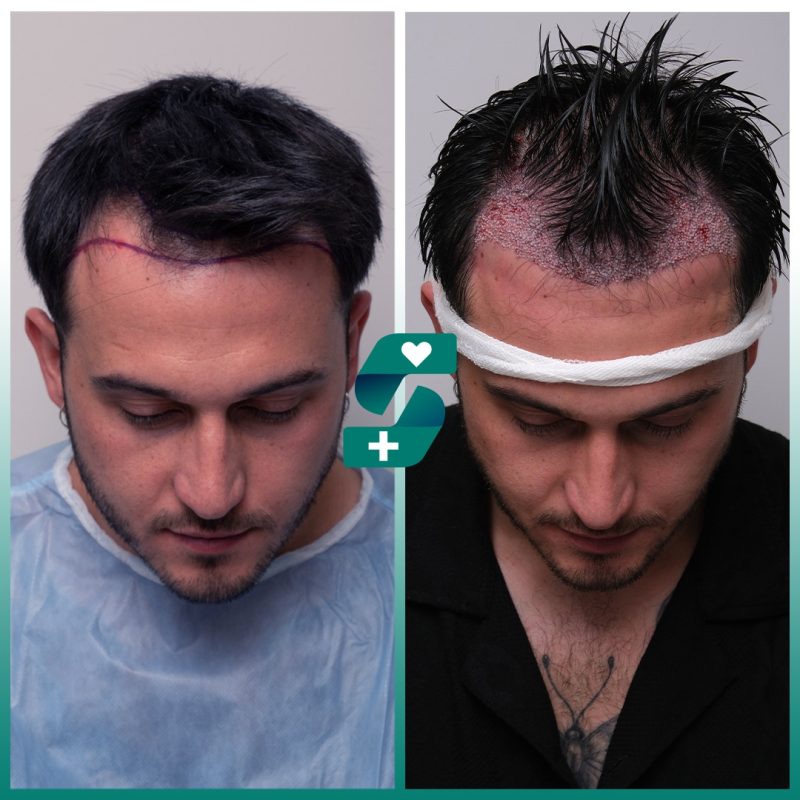 FUE Hair Transplant in Antalya - Process, Reviews Cost & Price 6 DHI Hair Transplant in Turkey