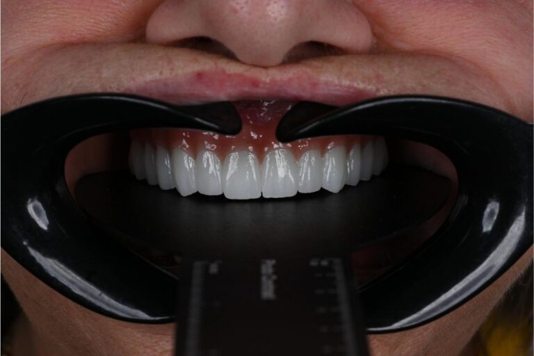 About Us 10 Full Mouth Dental Implants In Antalya 2025