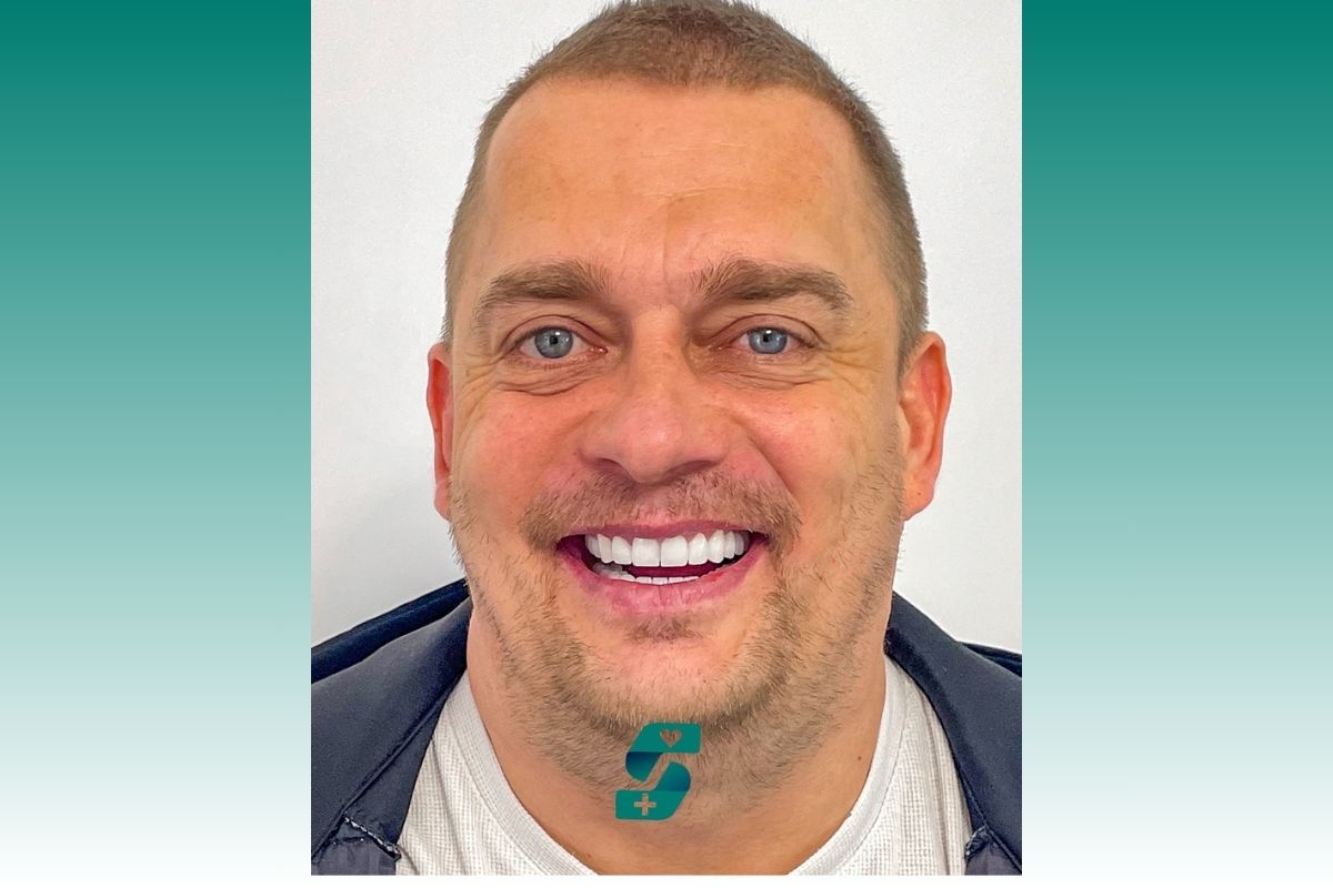 How Much Does Full Mouth Dental Implants Cost in Antalya? 3 What Is Full Mouth Dental Implants 2025