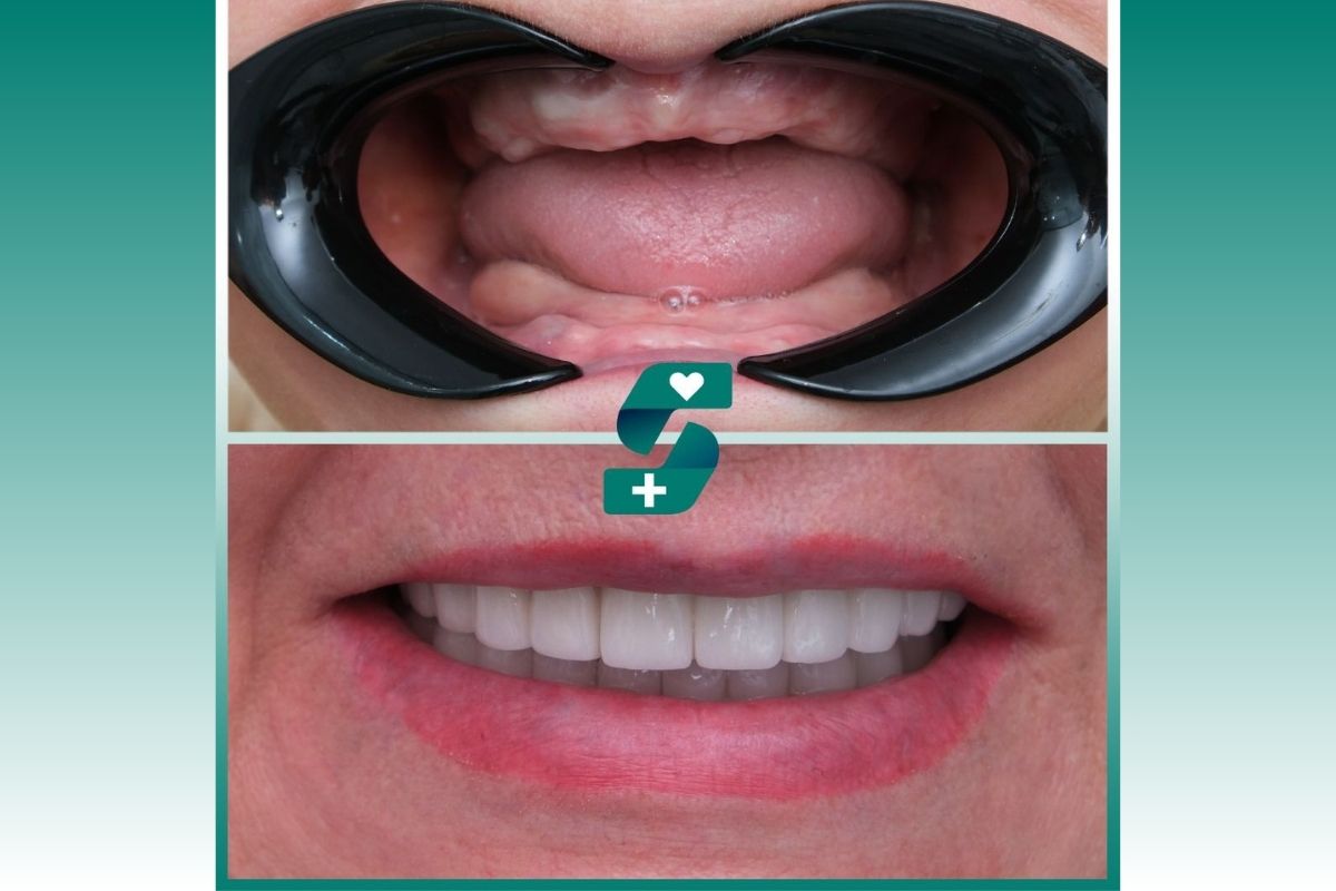 How Much Does Full Mouth Dental Implants Cost in Antalya? 4 Does A Full Mouth Dental Implant Hurt? 2025
