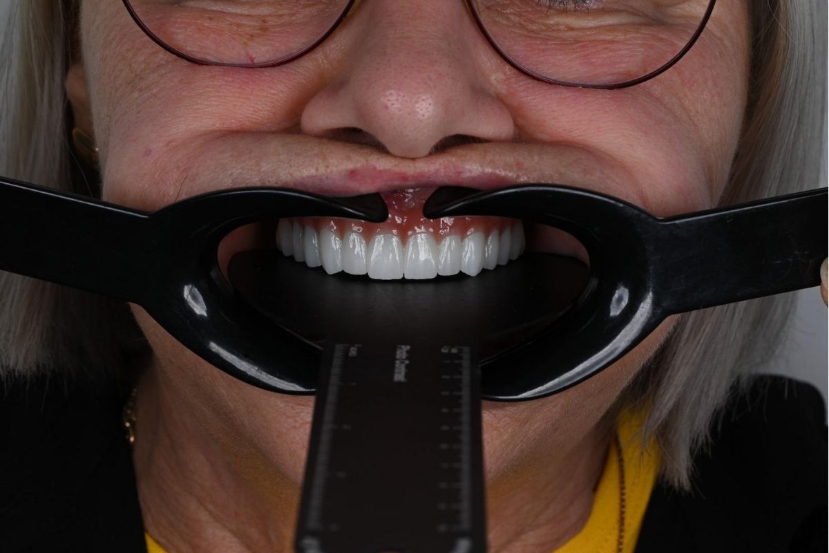 How Much Does Full Mouth Dental Implants Cost in Antalya? 2 How Much Does Full Mouth Dental Implants Cost In Antalya?