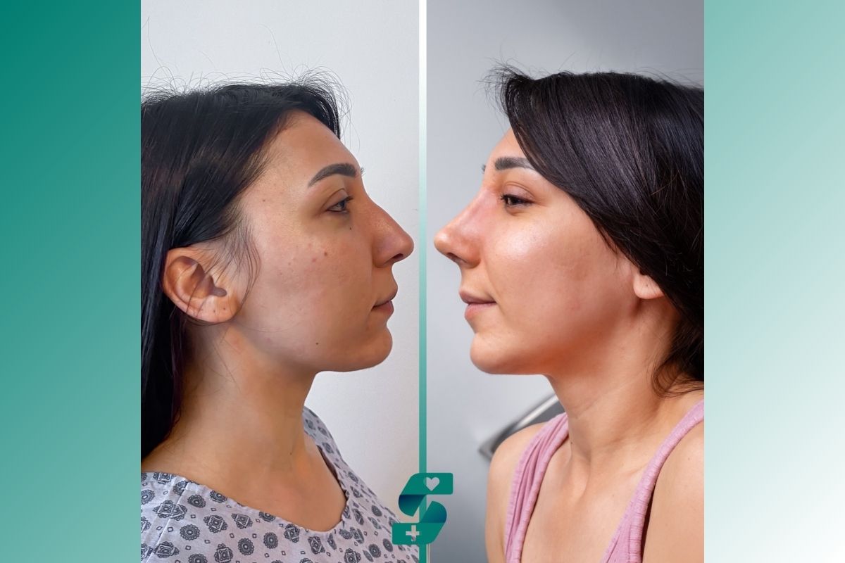 Nose Job in Antalya (Rhinoplasty) Cost Price - Soraca Med 2025 1 Before Nose Job In Antalya 2025