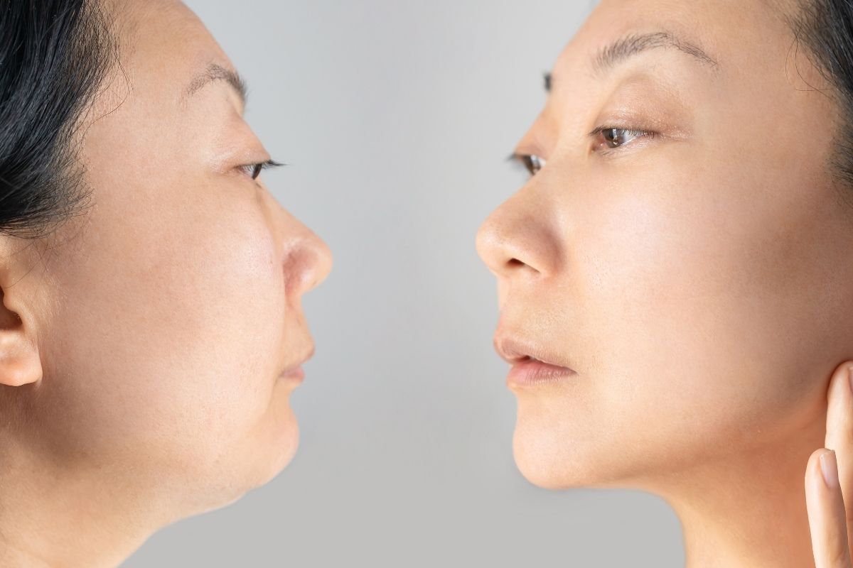 Smakro Liposuction Antalijoje