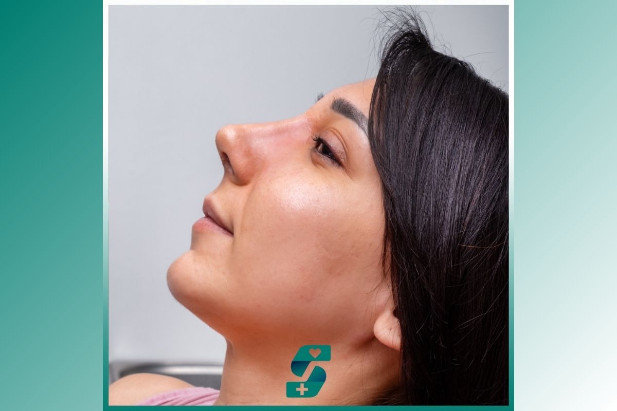 Nose Job in Antalya (Rhinoplasty) Cost Price - Soraca Med 2025 2 Nose Job In Antalya (Rhinoplasty) Cost Price - Soraca Med 2025