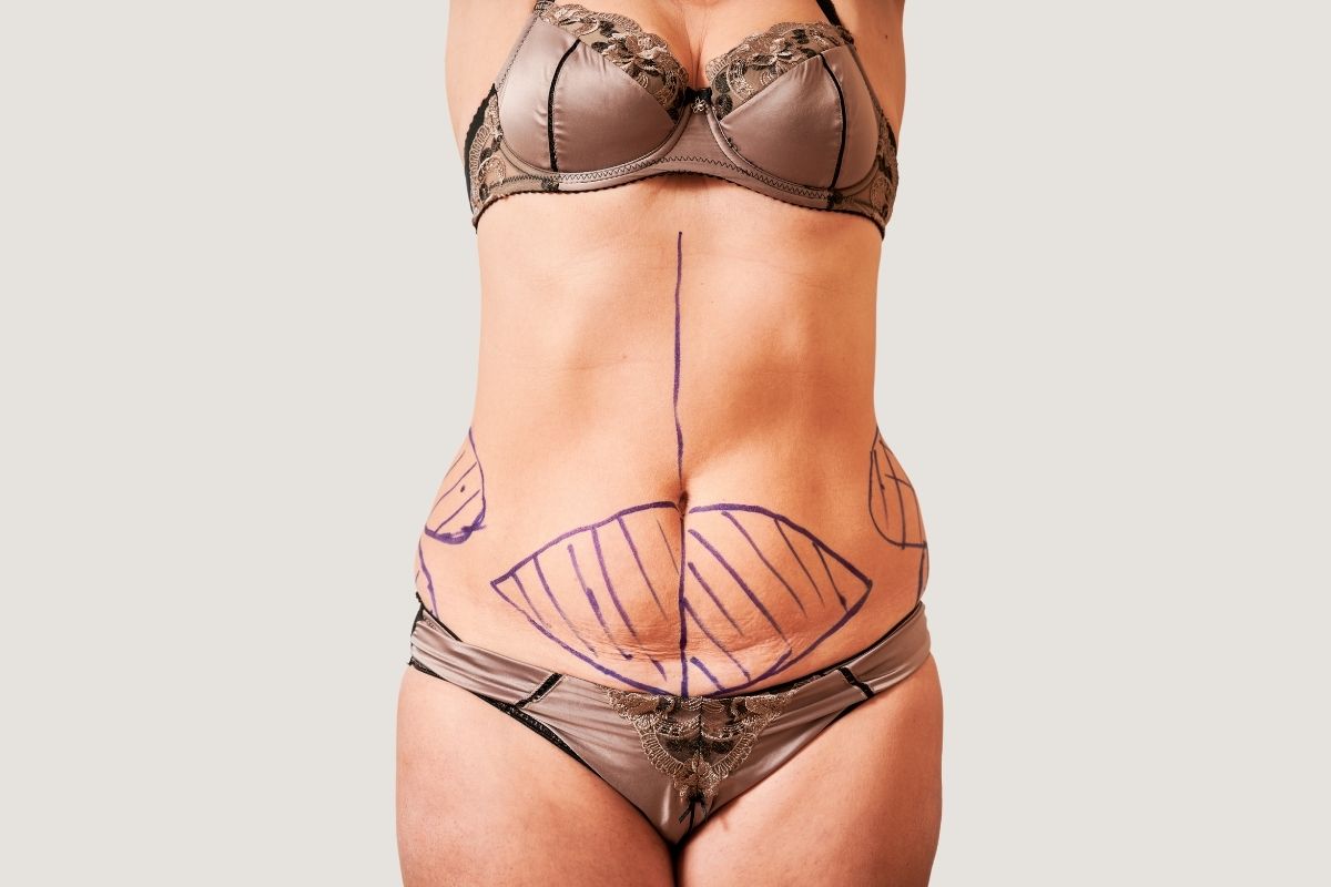 Extended Tummy Tuck Surgery in Antalya Procedure 2025 1 Extended Tummy Tuck Surgery In Antalya Procedure 2025