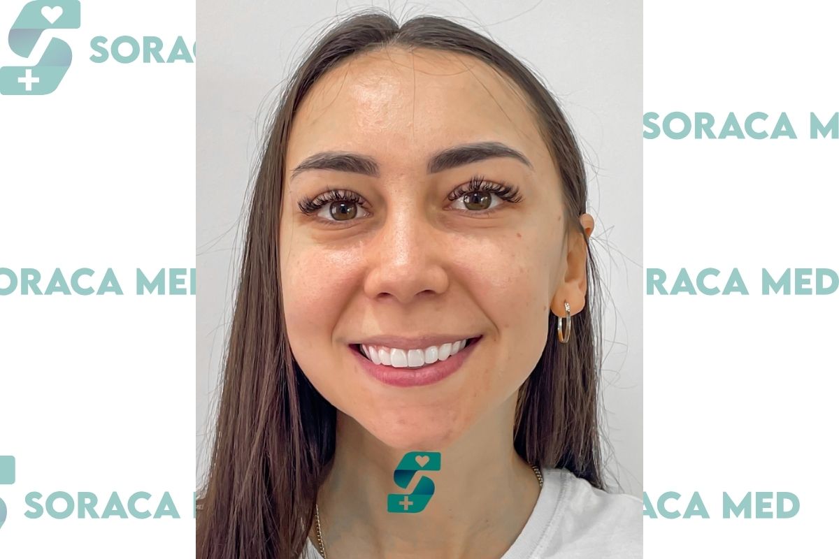Hollywood Smile in Antalya - Procedure & Reviews, Prices 2025 4 Hollywood Smile After