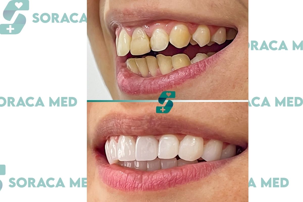 Hollywood Smile in Antalya - Procedure & Reviews, Prices 2025 5 Hollywood Smile In Antalya - Procedure &Amp; Reviews, Prices 2025