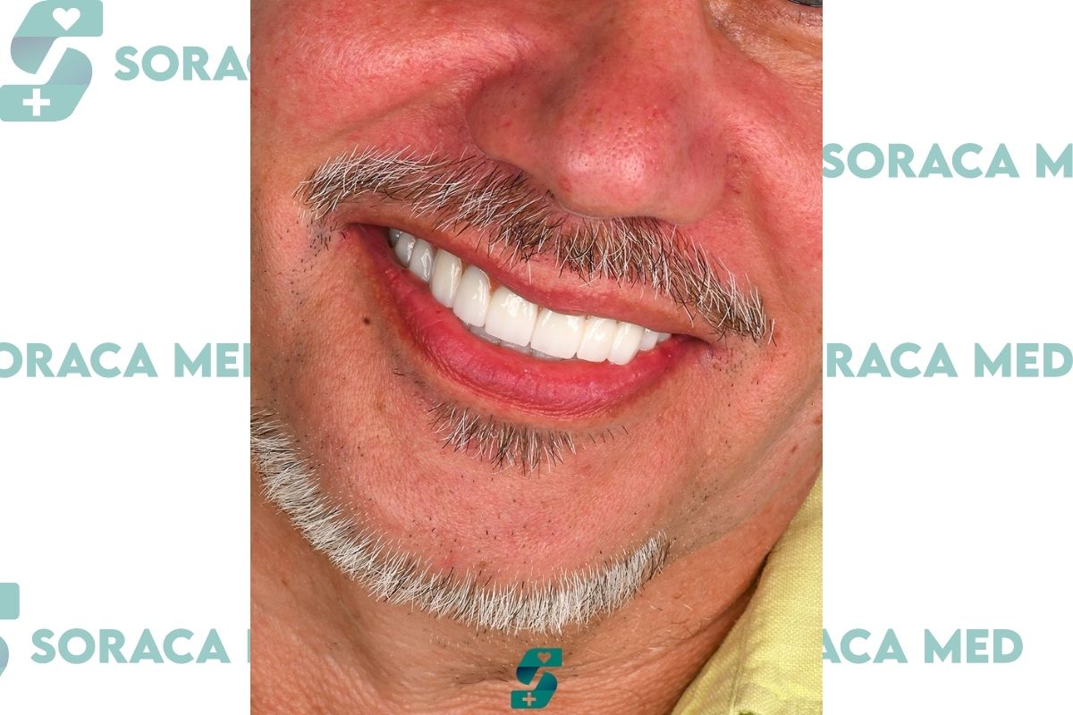 Hollywood Smile in Antalya - Procedure & Reviews, Prices 2025 1 Hollywood Smile In Antalya - Procedure &Amp; Reviews, Prices 2025