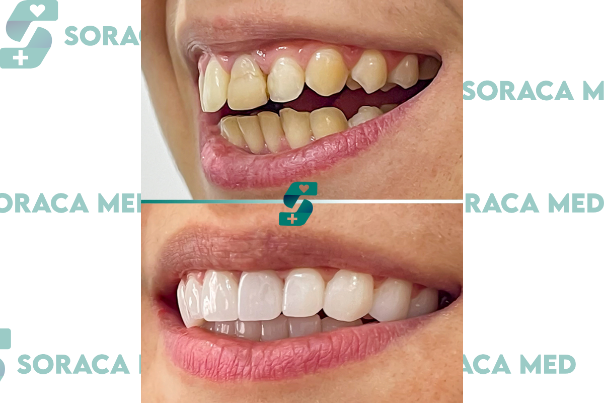 Zygomatic Implant in Antalya - Reviews, Cost, Procedure 2025 2 Zygomatic Implant Before After 2025