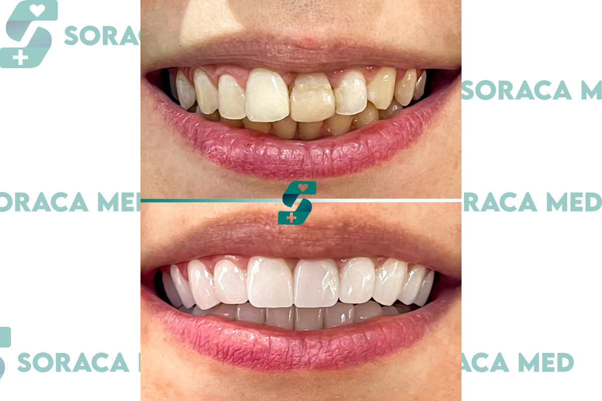 Zygomatic Implant in Antalya 2025