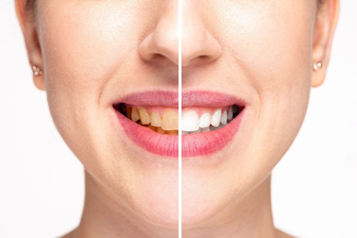 Teeth whitening in Antalya Before and After 2025