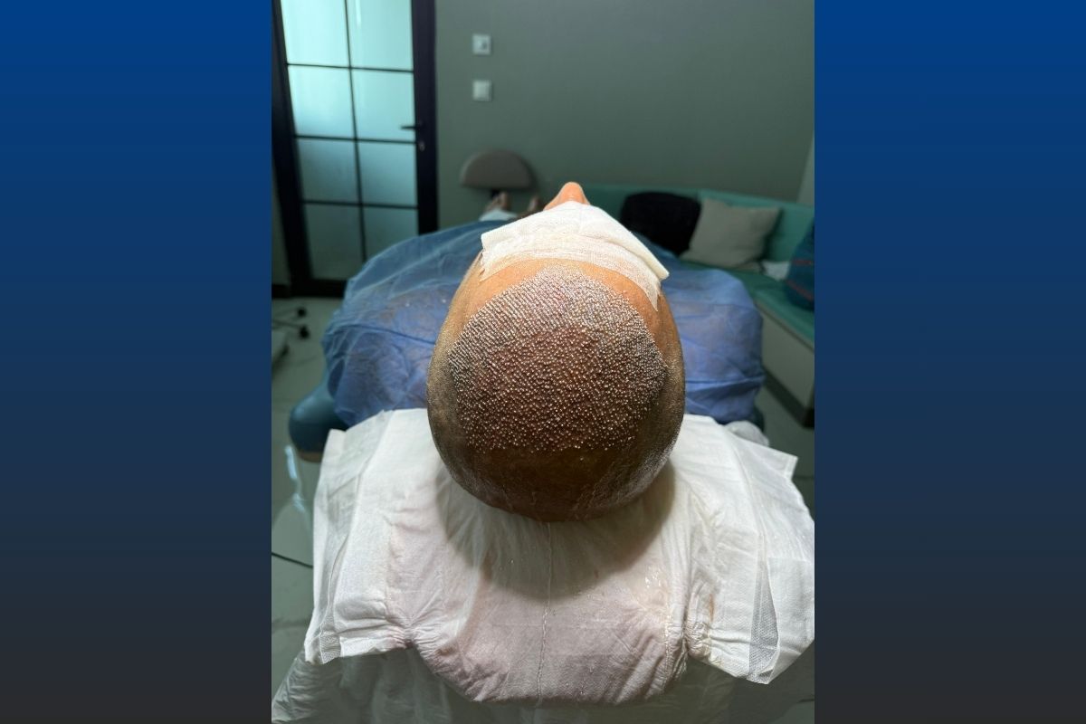 Hair Transplant in Istanbul Price List 2025