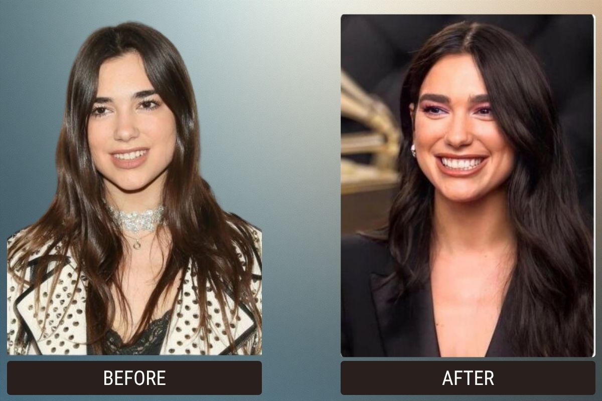 Hollywood Smile & Veneers: 5 Celebrity Before & After Photos 2 Hollywood Smile &Amp; Veneers: 5 Celebrity Before &Amp; After Photos