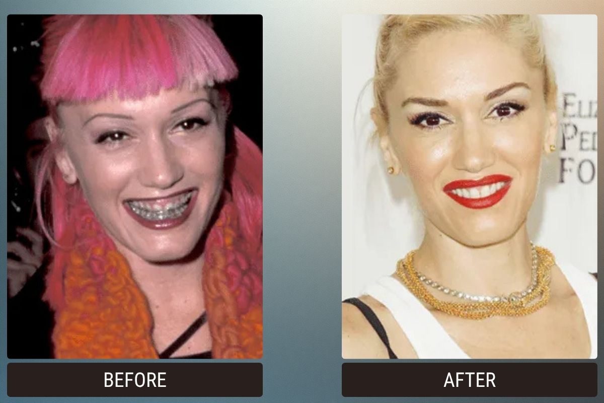 Hollywood Smile & Veneers: 5 Celebrity Before & After Photos 5 Gwen Stefani Tooth Transformation