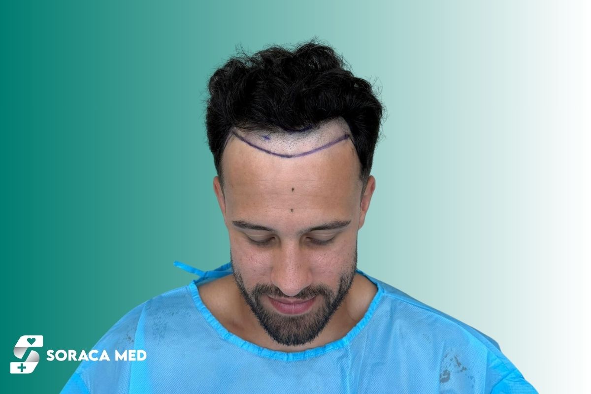No-Shave Hair Transplant Turkey – Prices & Results 2025 1 No-Shave Hair Transplant Turkey – Prices &Amp; Results 2025