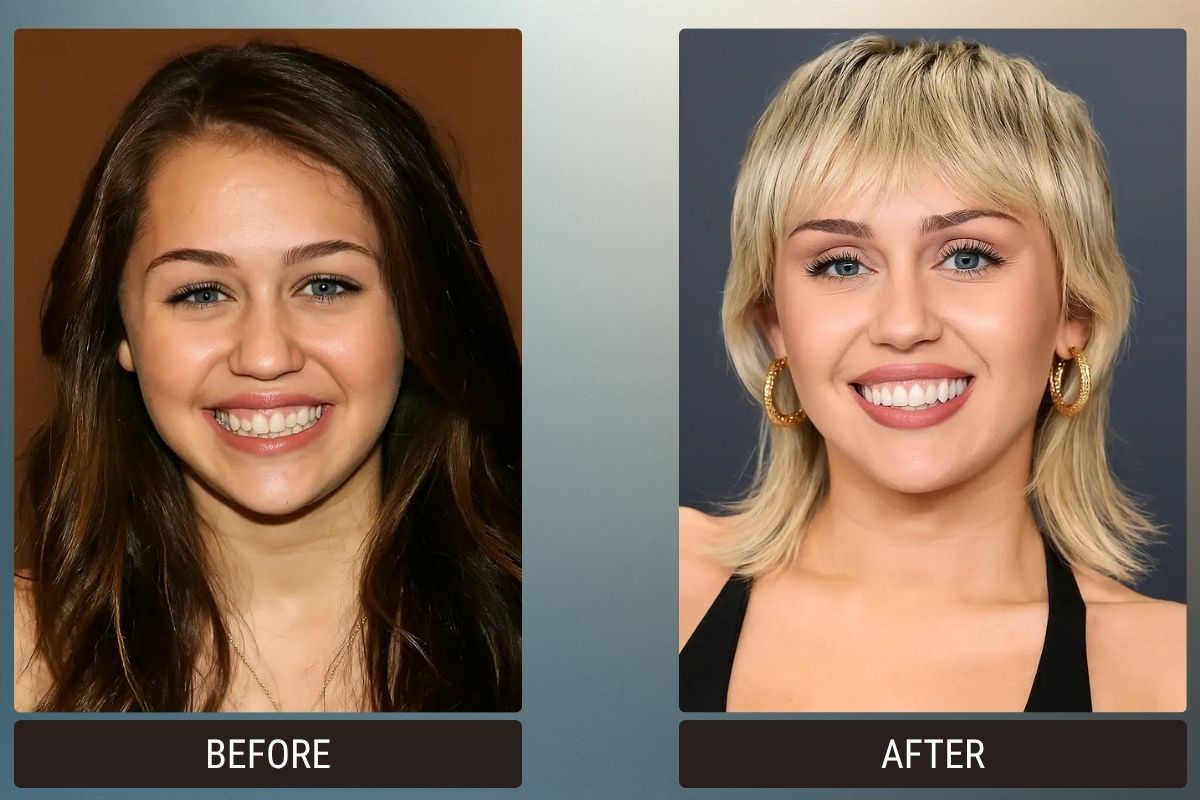 Hollywood Smile & Veneers: 5 Celebrity Before & After Photos 3 Hollywood Smile &Amp; Veneers: 5 Celebrity Before &Amp; After Photos