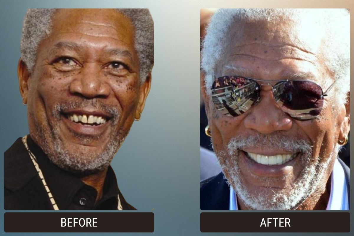 Hollywood Smile & Veneers: 5 Celebrity Before & After Photos 1 Hollywood Smile &Amp; Veneers: 5 Celebrity Before &Amp; After Photos