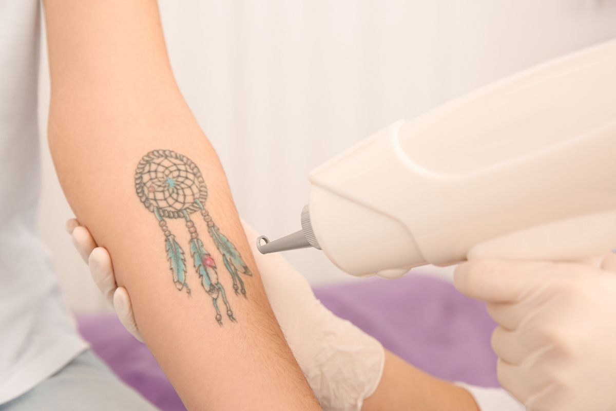 Tattoo Removal in Antalya - Reviews, Cost & Price 2025 1 Tattoo Removal In Antalya - Reviews, Cost &Amp; Price 2025