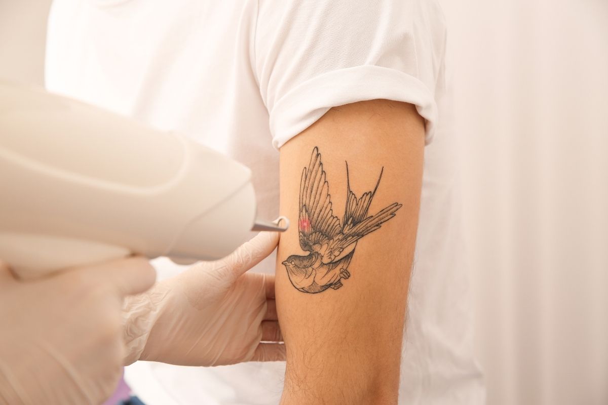 Tattoo Removal in Antalya - Reviews, Cost & Price 2025 2 Tattoo Removal In Antalya - Reviews, Cost &Amp; Price 2025