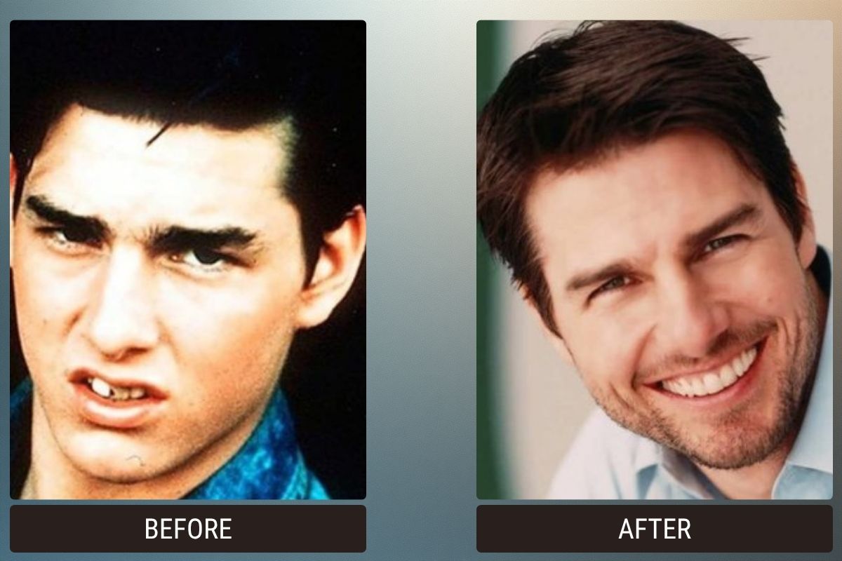 Hollywood Smile & Veneers: 5 Celebrity Before & After Photos 4 Hollywood Smile &Amp; Veneers: 5 Celebrity Before &Amp; After Photos