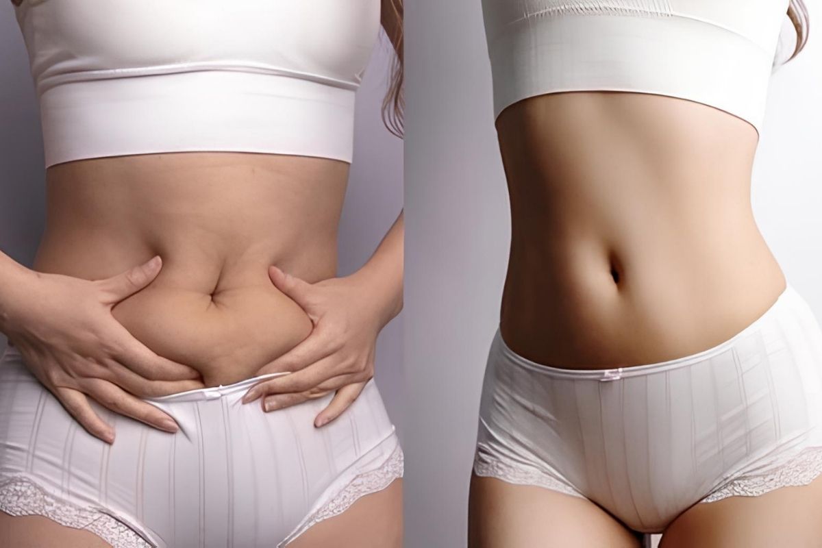 360 Liposuction In Antalya Turkey