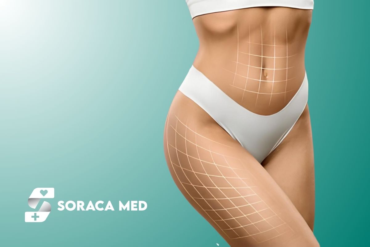Abdominal Etching & 360 Liposuction in Antalya Turkey