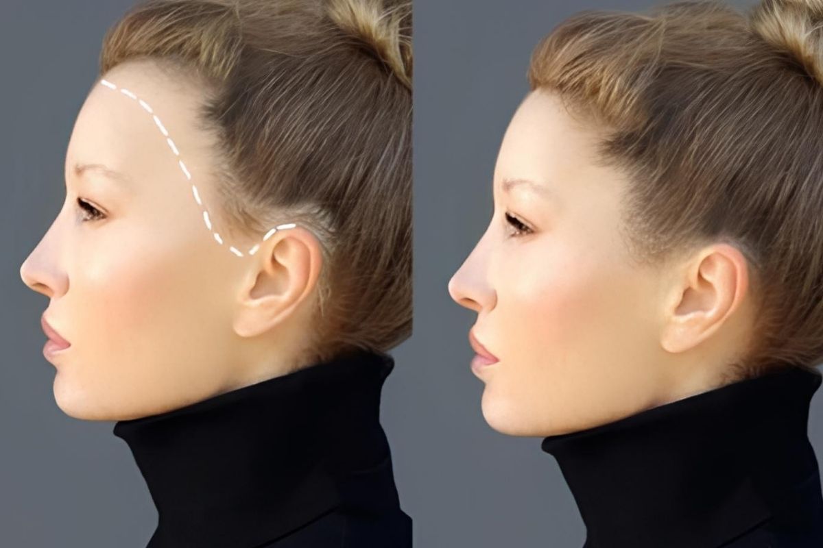 Haartransplantation Türkei, Antalya: Was verschweigen Kliniken? 2 Haartransplantation Türkei, Antalya: Was Verschweigen Kliniken?