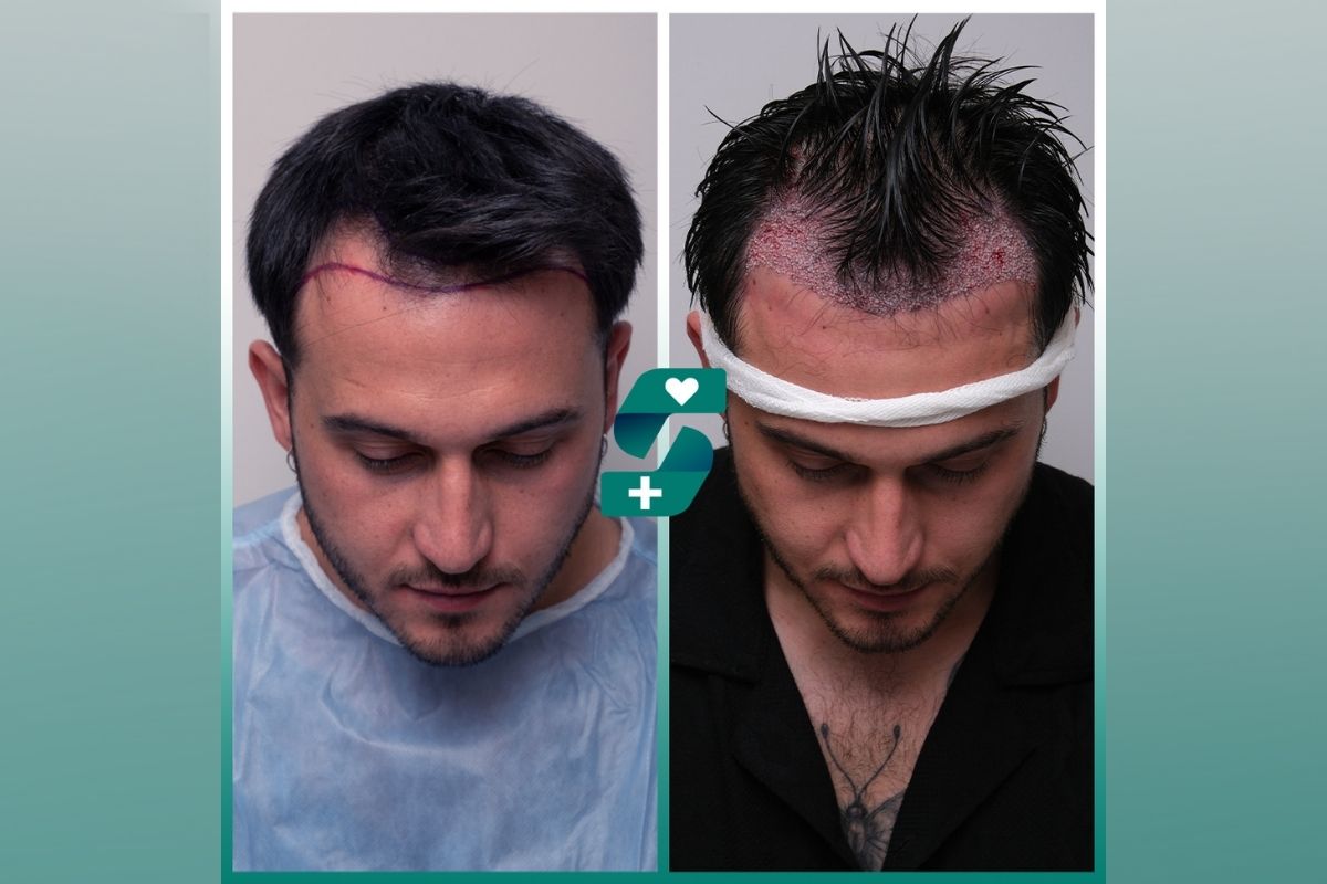 Haartransplantation Türkei, Antalya: Was verschweigen Kliniken?
