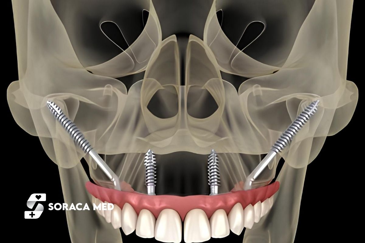 How Long Do Zygomatic Implants Last