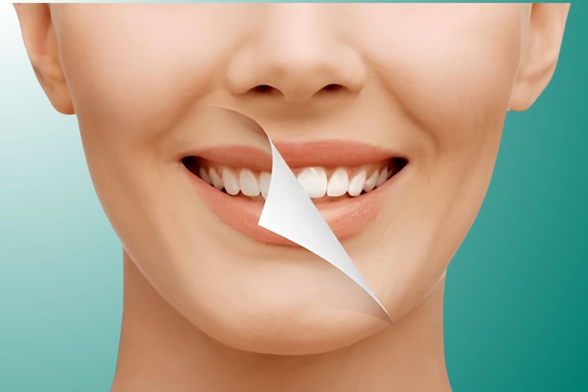 Impianti Dentali ad Antalya, Turchia