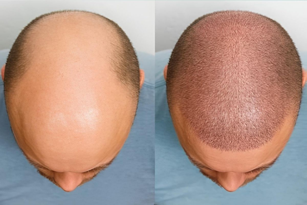 Haartransplantation Türkei, Antalya: Was verschweigen Kliniken? 1 Haartransplantation Türkei, Antalya: Was Verschweigen Kliniken?