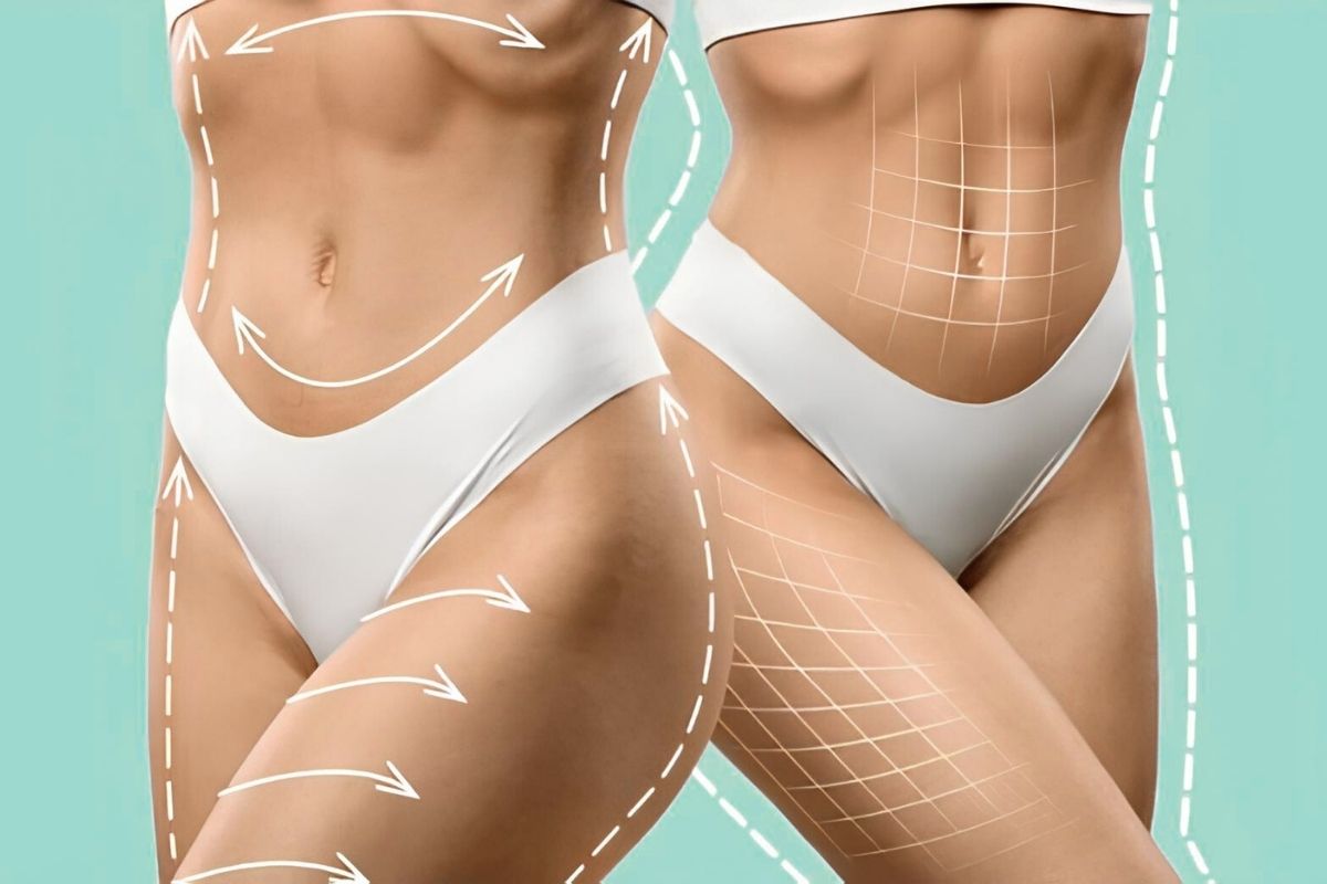 What Is The Difference Between Abdominal Etching And Regular Liposuction